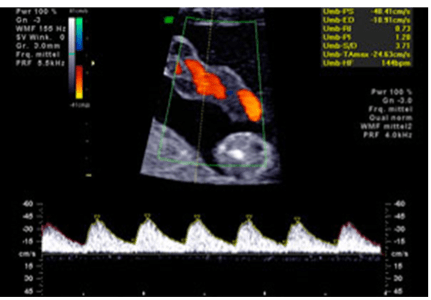 Doppler der Nabelschnurarterie